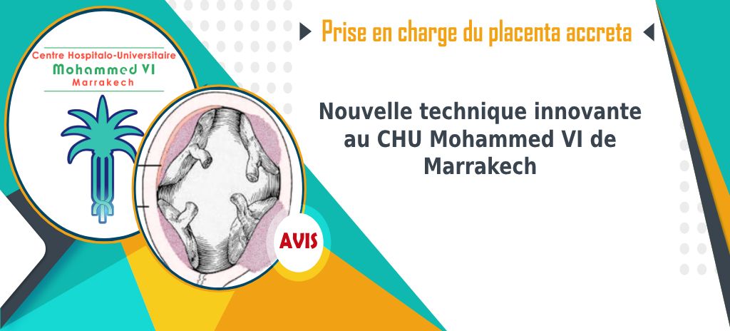 Prise en charge du placenta accreta: nouvelle technique innovante au CHU Mohammed VI de Marrakech