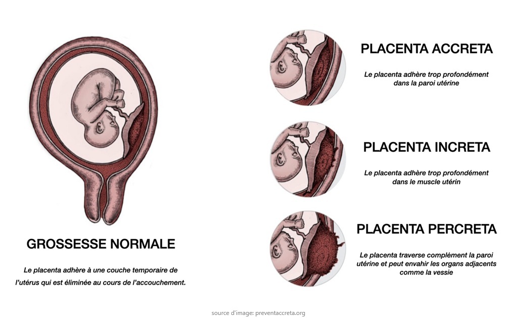 Placenta accreta 21052025